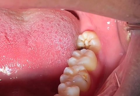 Nhổ Răng Khôn Có Nguy Hiểm Không? Biến Chứng Nhổ Răng Là Gì